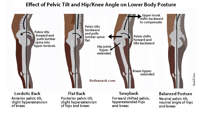 Cross-section diagram of effects of pelvic tilt and hip/knee angle on lower back pain
