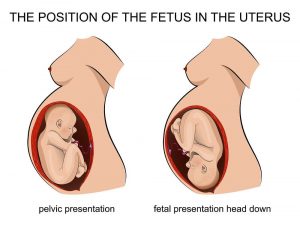 The position of the fetus in the uterus diagram
